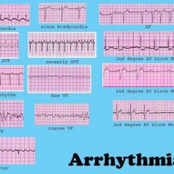 Ascension basic cardiac rhythms virtual course post test 1