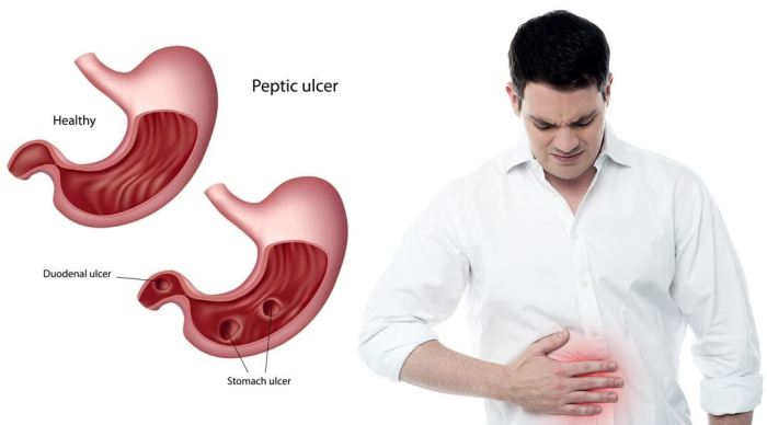 Enterorrhaphy for perforated ulcer small intestine single perforation